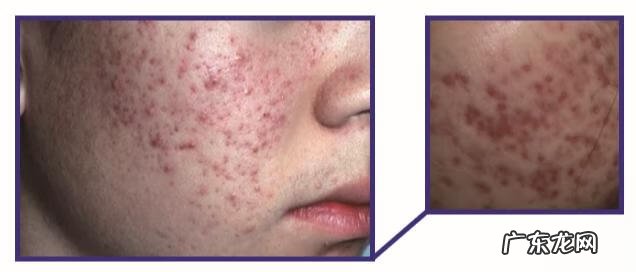 脸上长痤疮的图片 脸部痤疮图片