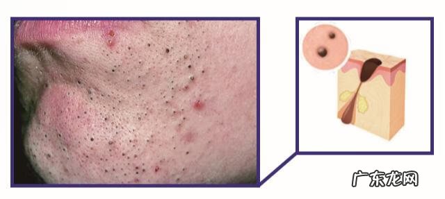 脸上长痤疮的图片 脸部痤疮图片