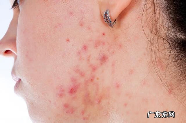 治疗痤疮有哪些方法 治疗痤疮方法有哪些