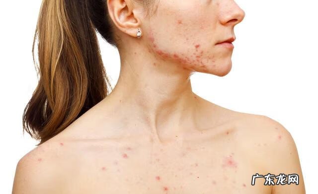 治疗痤疮有哪些方法 治疗痤疮方法有哪些