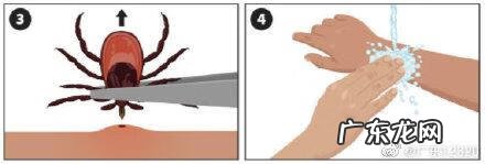 蜱虫咬人有多严重 蜱虫咬人后有什么症状,怎么治疗