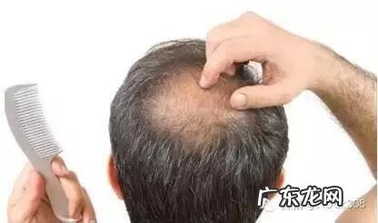 头发稀少怎么办 前面头顶头发稀少怎么办