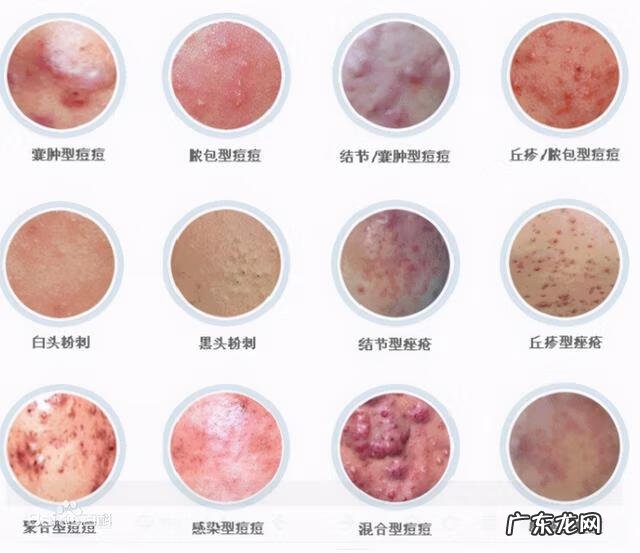 粉刺和痤疮怎么治疗 医治痤疮粉刺