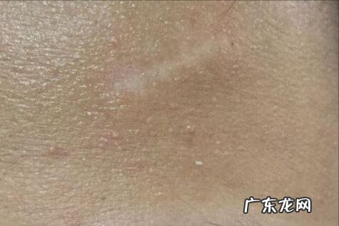 最先进的祛疤技术 去疤痕最好的方法是什么