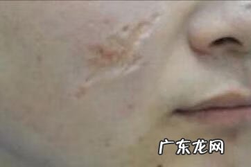 最先进的祛疤技术 去疤痕最好的方法是什么