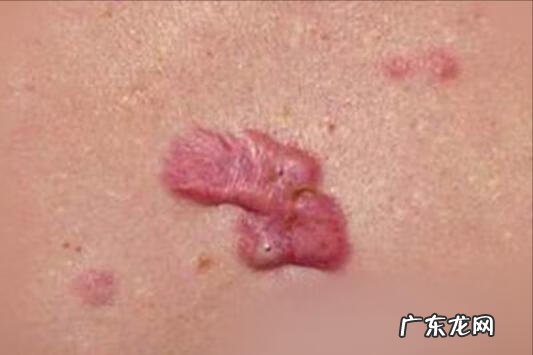 最先进的祛疤技术 去疤痕最好的方法是什么