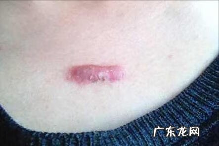 最先进的祛疤技术 去疤痕最好的方法是什么