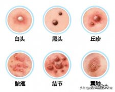青春痘和粉刺 青春痘粉刺痤疮