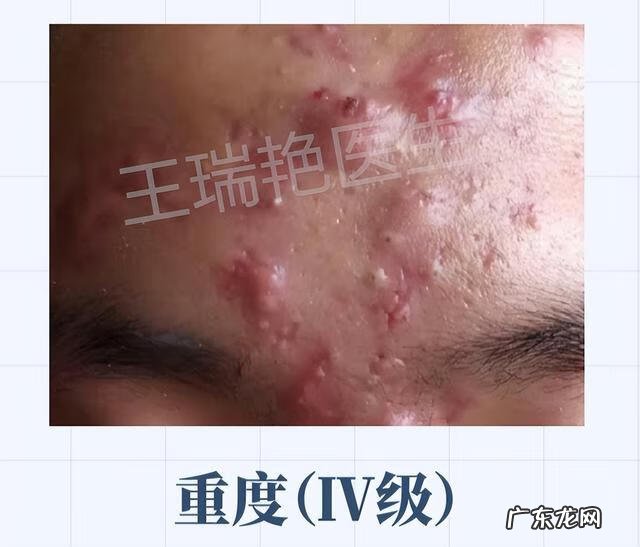 脸上长痘痘位置原因图解 脸上长痘痘的位置图及详解