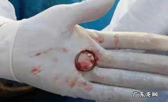 上避孕环需要注意什么 避孕环图示