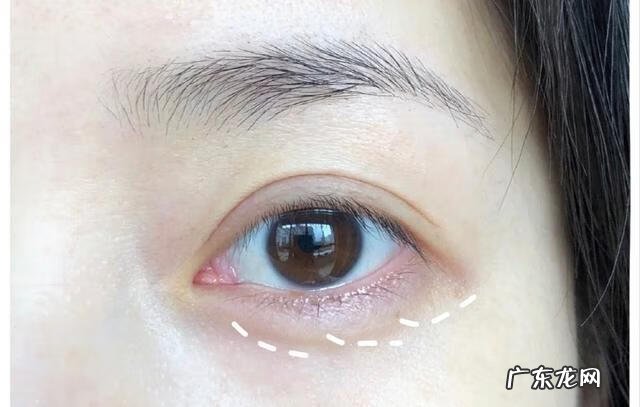 眼袋眼角纹怎么消除 消除眼角皱纹有什么方法