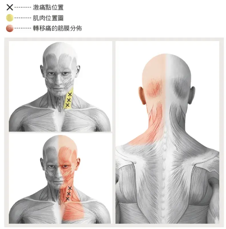 胸锁乳突肌在哪个位置 胸锁乳突肌位置