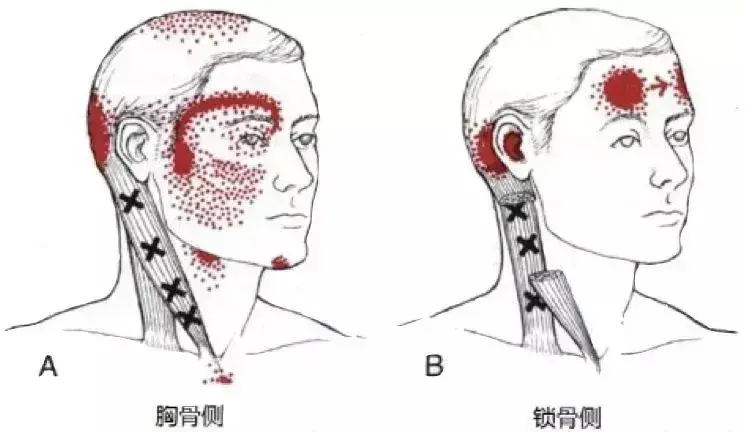 胸锁乳突肌在哪个位置 胸锁乳突肌位置