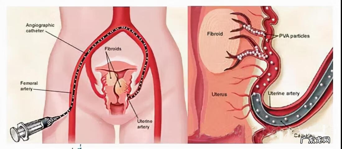 子宫腺肌症是什么病怎么引起的 什么是子宫腺肌症?