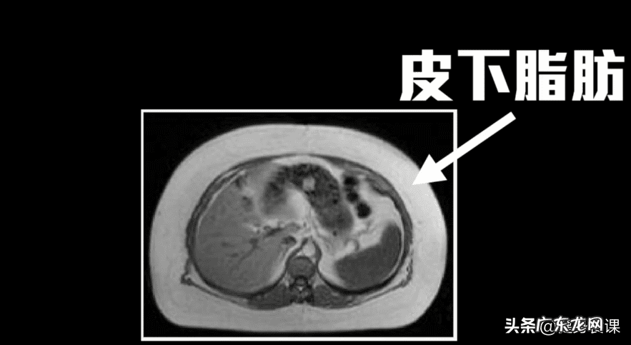 抽脂真的能减肥吗 抽脂减肥效果如何
