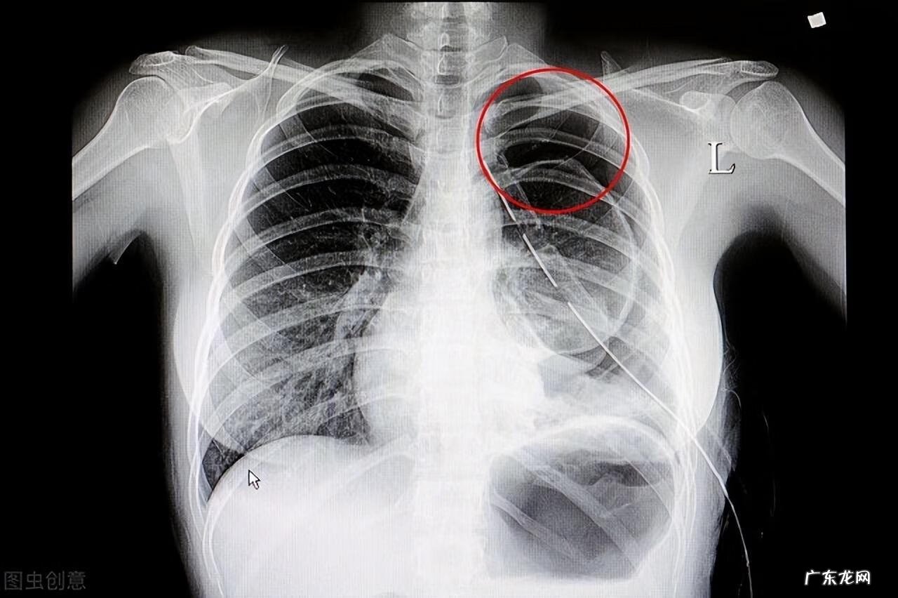 气胸的症状及体征表现 气胸症状有哪些
