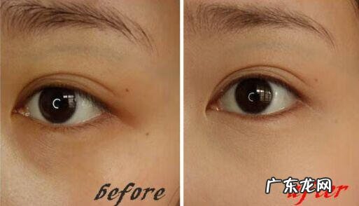 快速去掉黑眼圈的方法 快速去掉黑眼圈方法