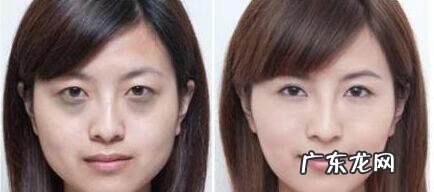 快速去掉黑眼圈的方法 快速去掉黑眼圈方法