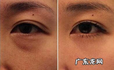 快速去掉黑眼圈的方法 快速去掉黑眼圈方法