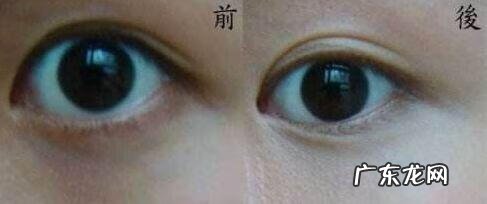 快速去掉黑眼圈的方法 快速去掉黑眼圈方法