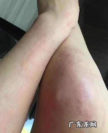 过敏全身 全身皮肤过敏是什么原因引起