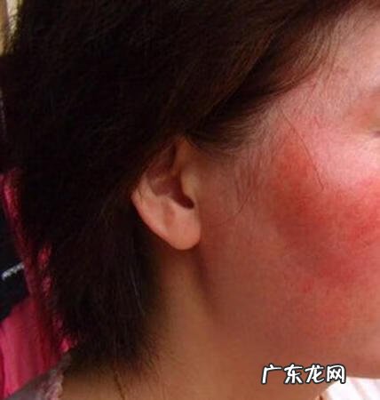 过敏全身 全身皮肤过敏是什么原因引起