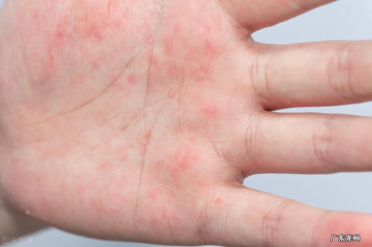 汗疱性湿疹怎么治疗 汗疹怎么治疗最快方法