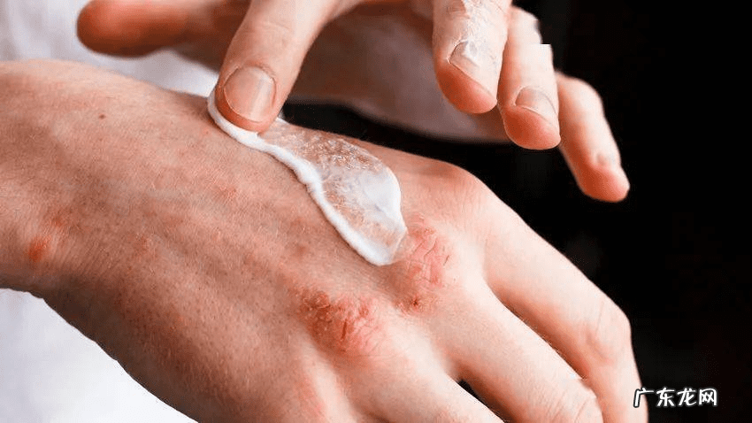 汗疱性湿疹怎么治疗 汗疹怎么治疗最快方法