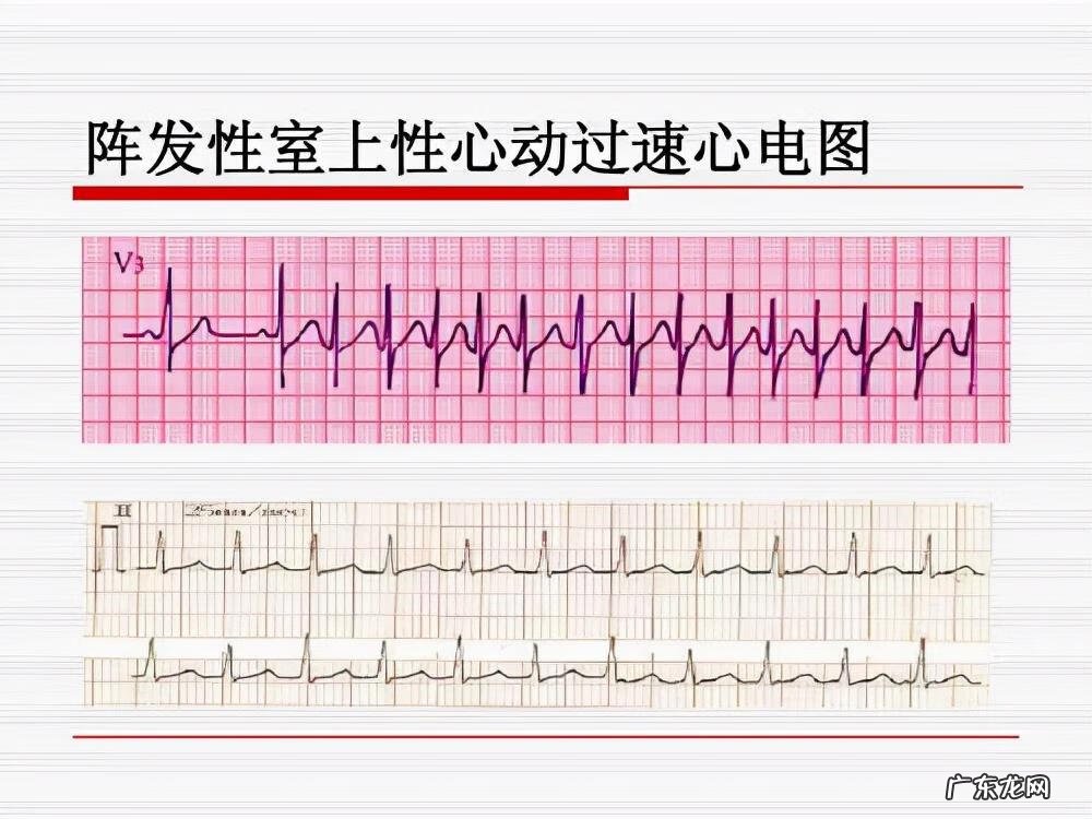 运动完一分钟心跳多少正常 运动后一分钟心跳多少次
