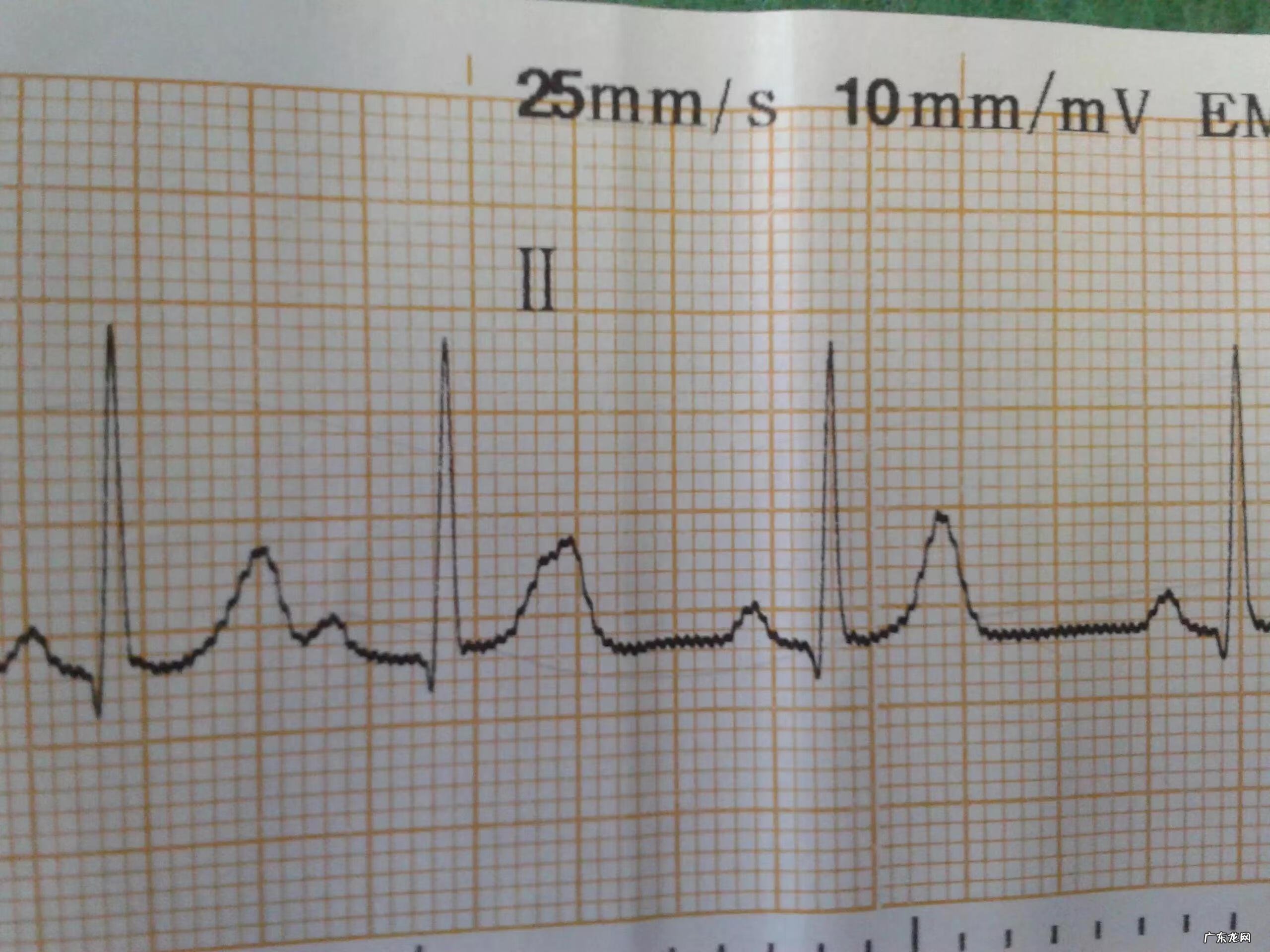 心律失常是什么情况 心律失常能自己恢复吗