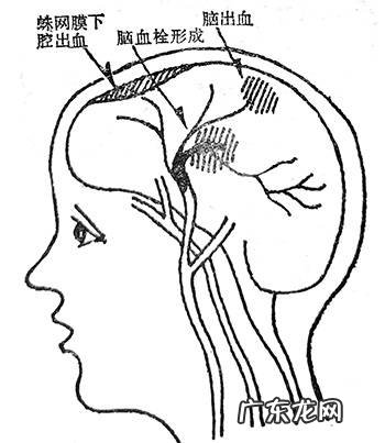 中风的种类及预防