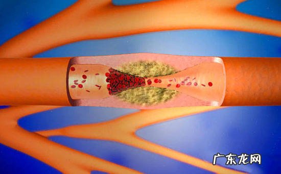 动脉硬化的诱发因素和治疗预防