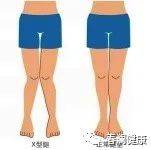 小谈X型腿的成因及预防