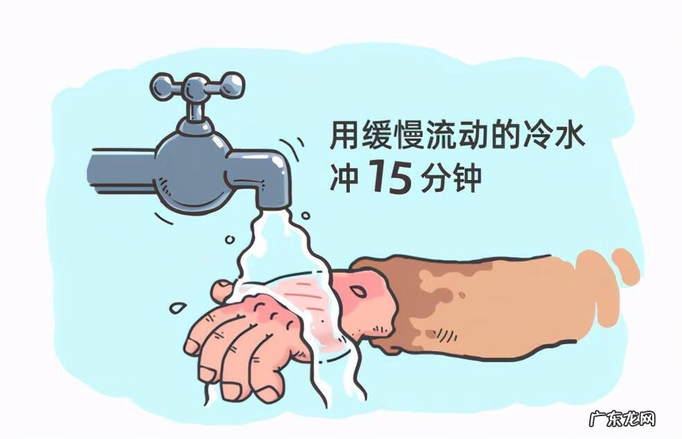 烫伤处理步骤 烫伤处理方法正确的是