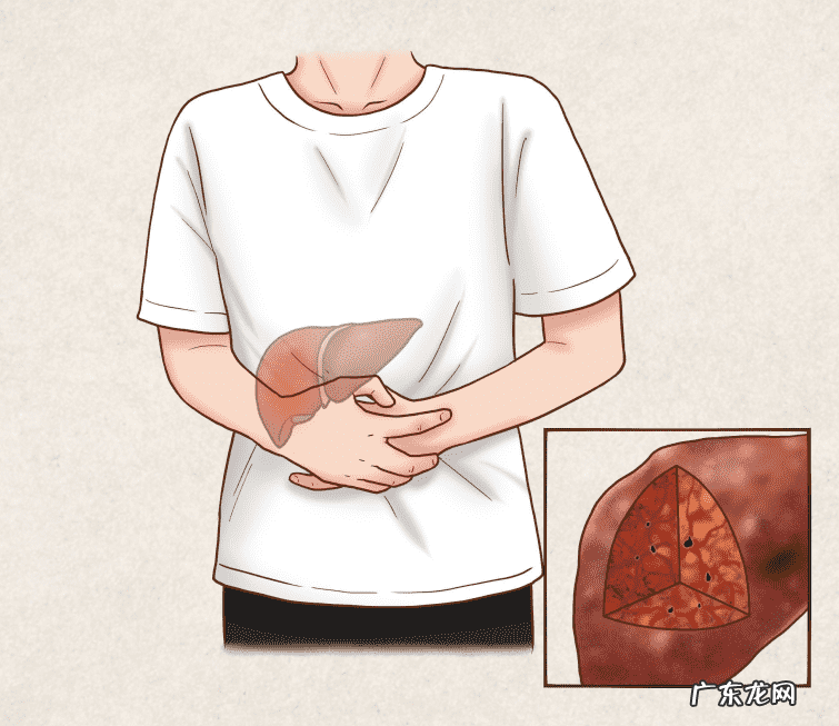 肝功能异常的原因、表现及如何预防