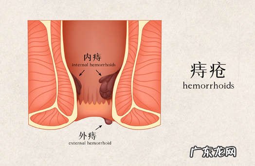 容易引起痔疮的4个坏习惯