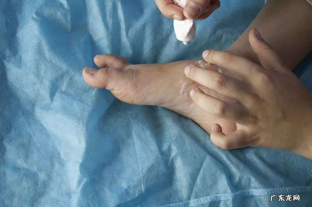 脚气的各种症状及正确治疗方法