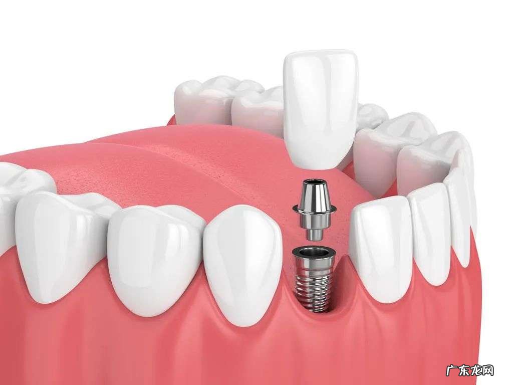 牙龈出血、蛀牙、假牙等牙齿健康问题解答