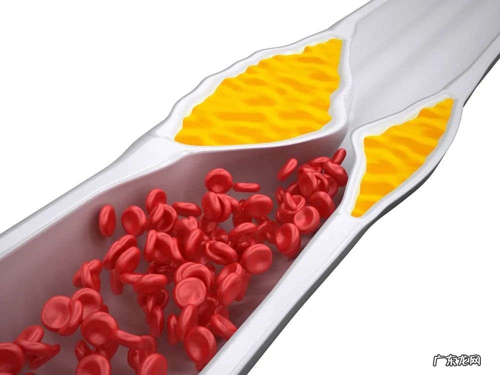 血糖偏高引起血管堵塞的自测及预防