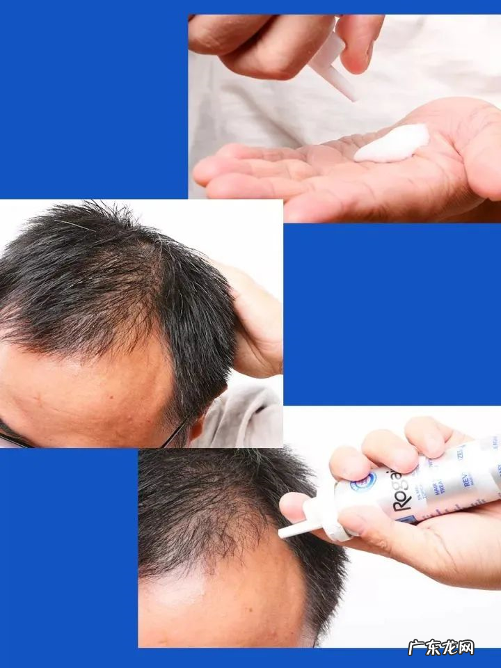 怎样使用米诺地尔,生发更有效?