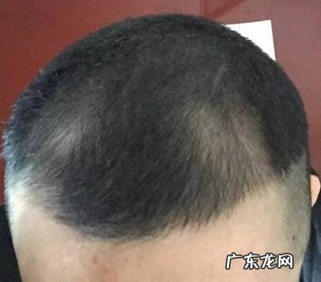 米诺地尔对前额脱发有效吗？