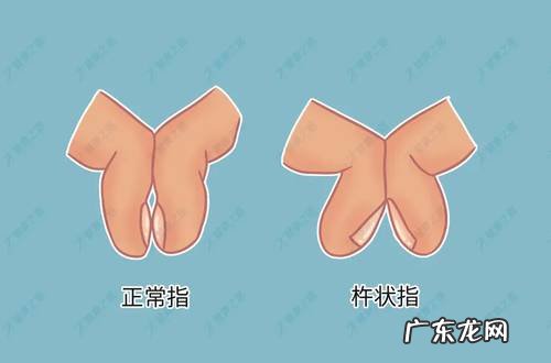 杵状指的辨别、就医检查及预防