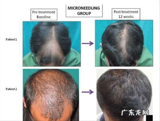 微针滚轮搭配米诺地尔一起使用能提高吸收率吗?