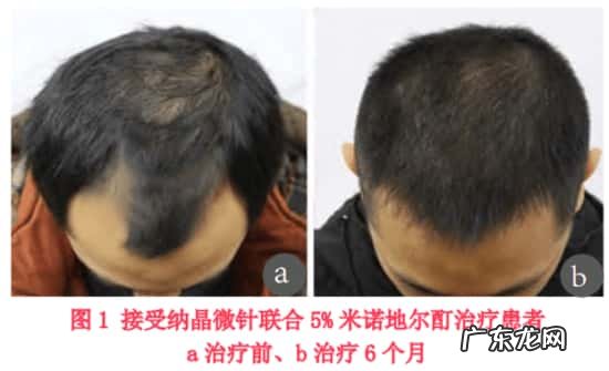 微针滚轮搭配米诺地尔一起使用能提高吸收率吗?