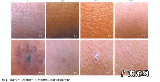 微针滚轮搭配米诺地尔一起使用能提高吸收率吗?