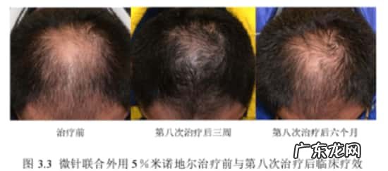 微针滚轮搭配米诺地尔一起使用能提高吸收率吗?