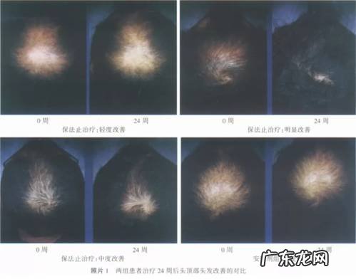 脱发用非那雄胺效果怎样?能生发吗?