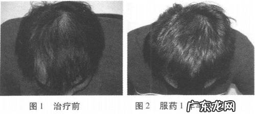 脱发用非那雄胺效果怎样?能生发吗?