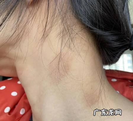 小柴胡治皮肤病医案分享