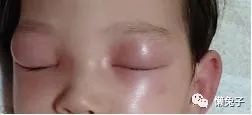 巧用蒲公英治孩子眼睛肿胀医案